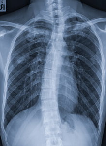 How to Manage Mild Scoliosis at Home