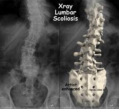 Explore Adult Scoliosis Causes: Symptoms, Treatment & More