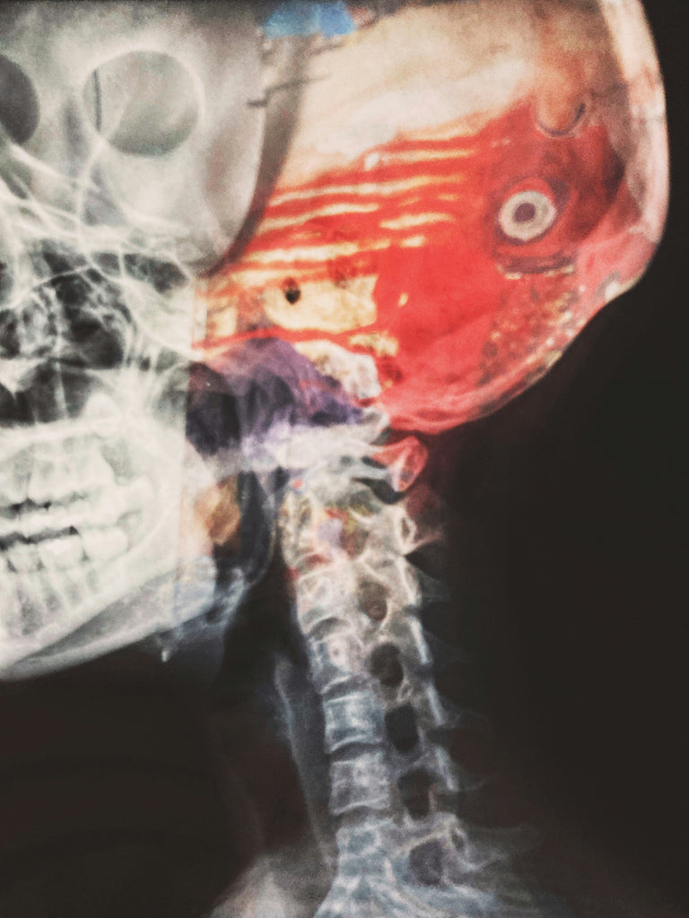 Scoliosis and Brain Tumors: How they're Linked